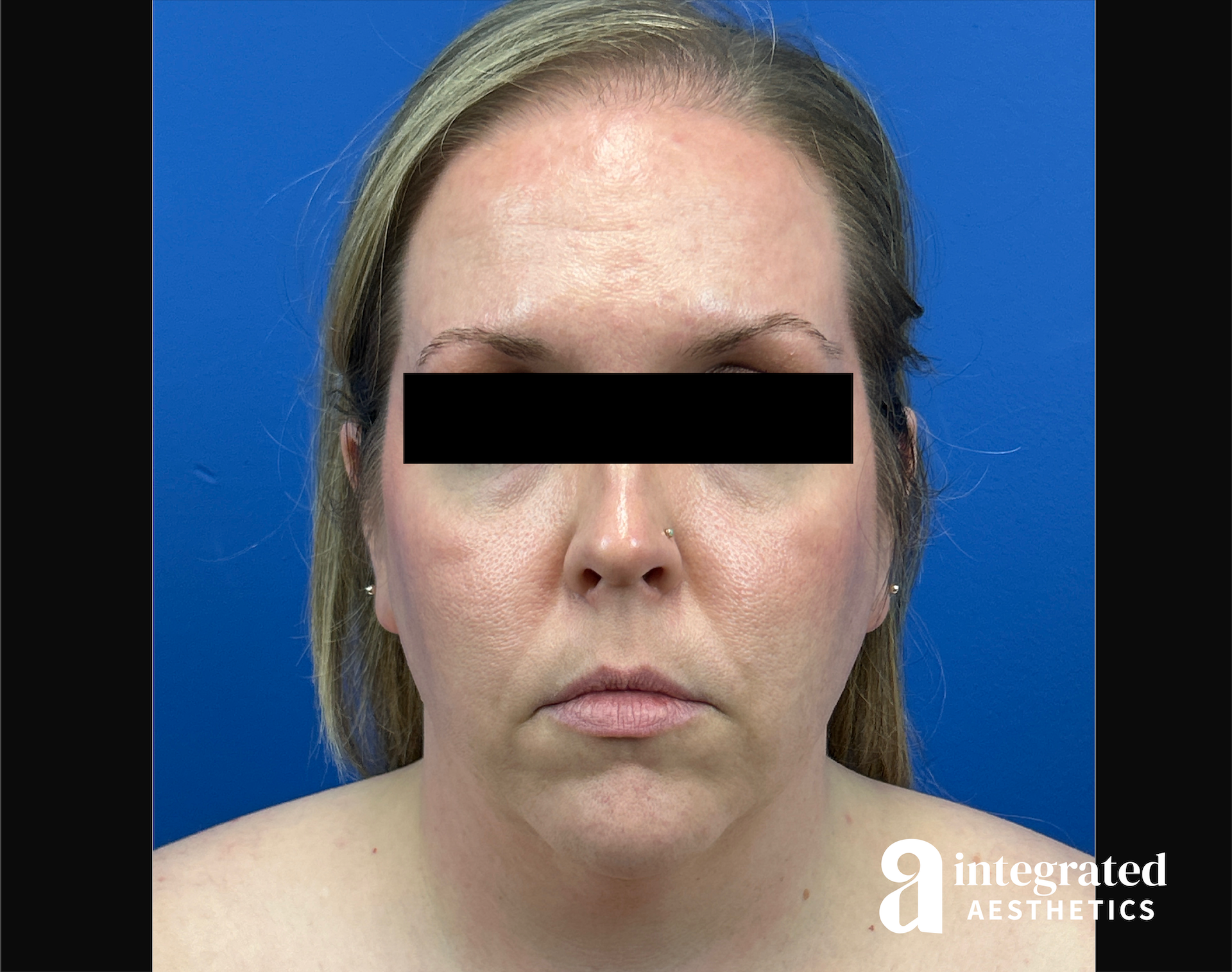 Facelift & Neck Lift Before & After Gallery - Patient 746941 - Image 1