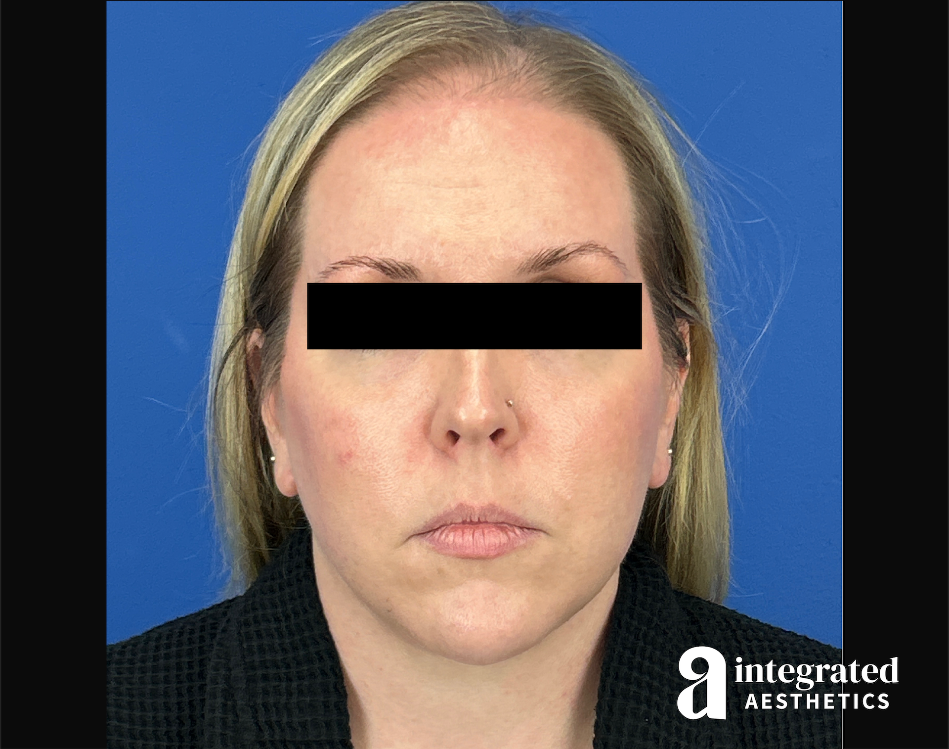 Facelift & Neck Lift Before & After Gallery - Patient 746941 - Image 2