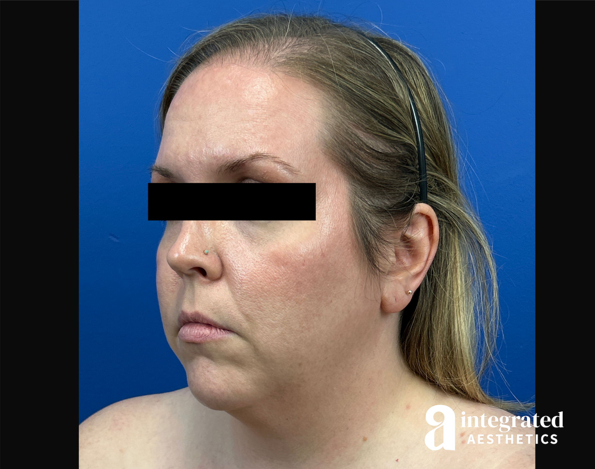 Facelift & Neck Lift Before & After Gallery - Patient 746941 - Image 7