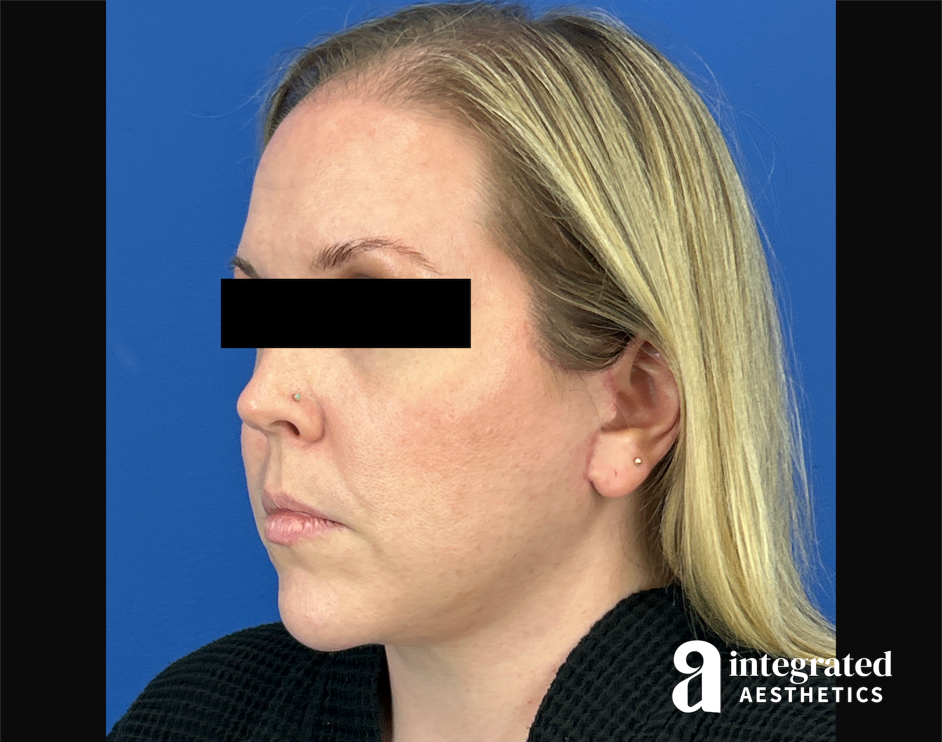 Facelift & Neck Lift Before & After Gallery - Patient 746941 - Image 8