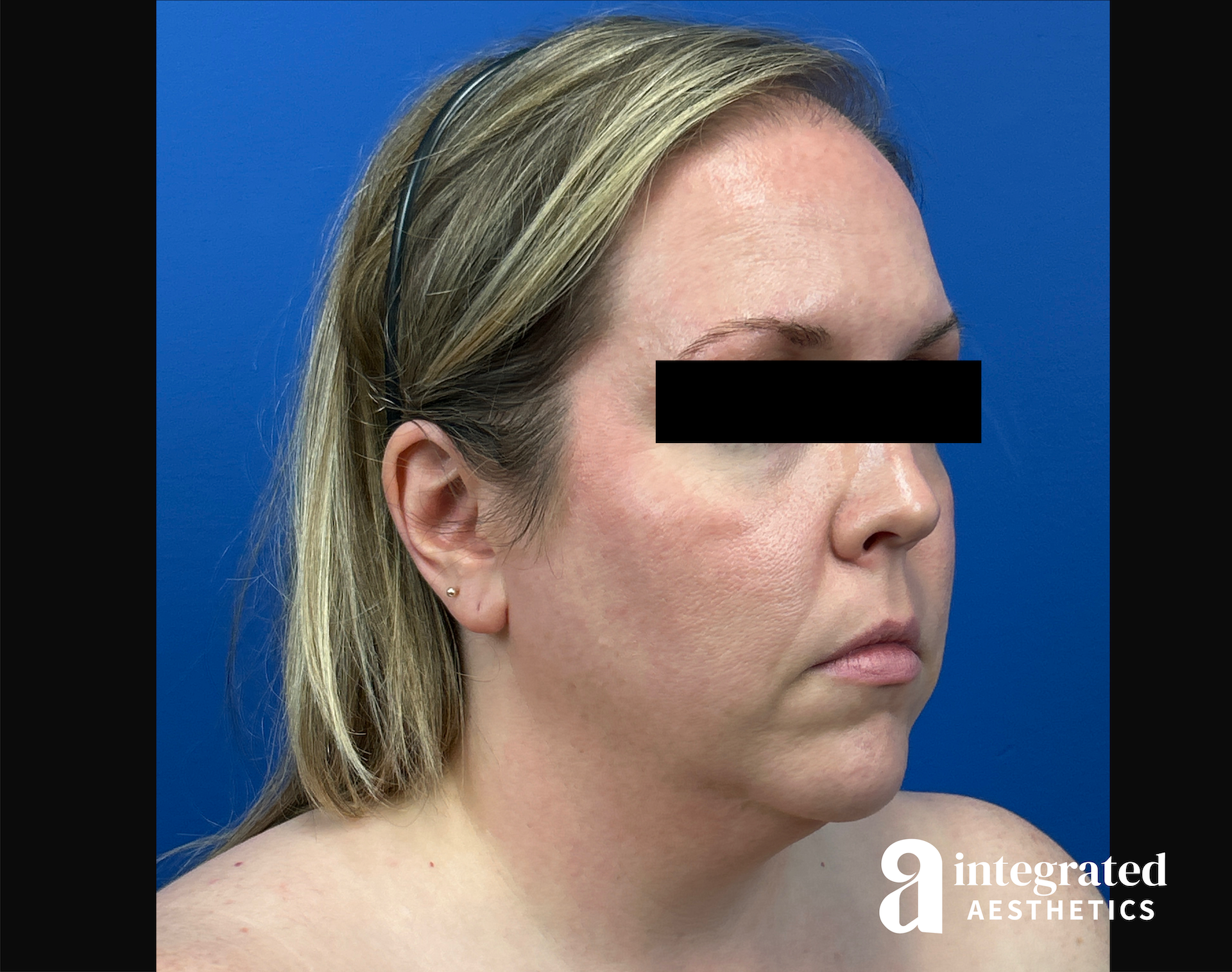 Facelift & Neck Lift Before & After Gallery - Patient 746941 - Image 3