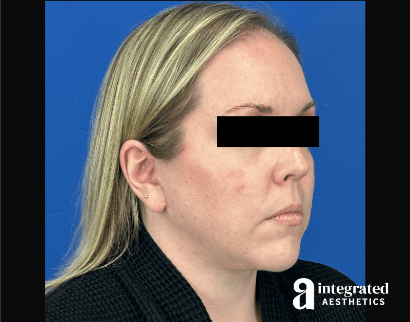 Facelift & Neck Lift Before & After Gallery - Patient 746941 - Image 4