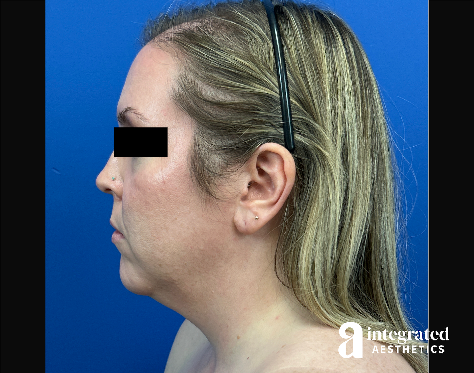 Facelift & Neck Lift Before & After Gallery - Patient 746941 - Image 11