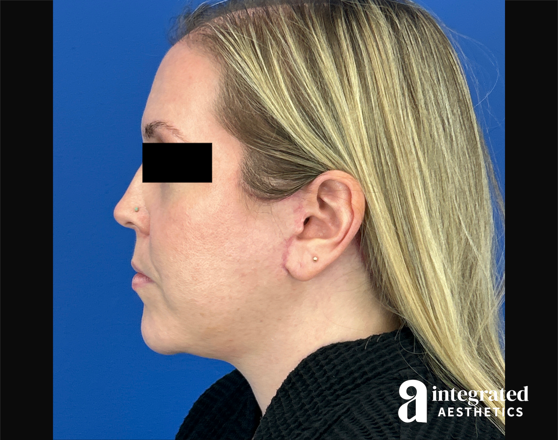 Facelift & Neck Lift Before & After Gallery - Patient 746941 - Image 12