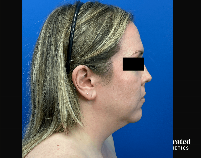 Facelift & Neck Lift Before & After Gallery - Patient 746941 - Image 5