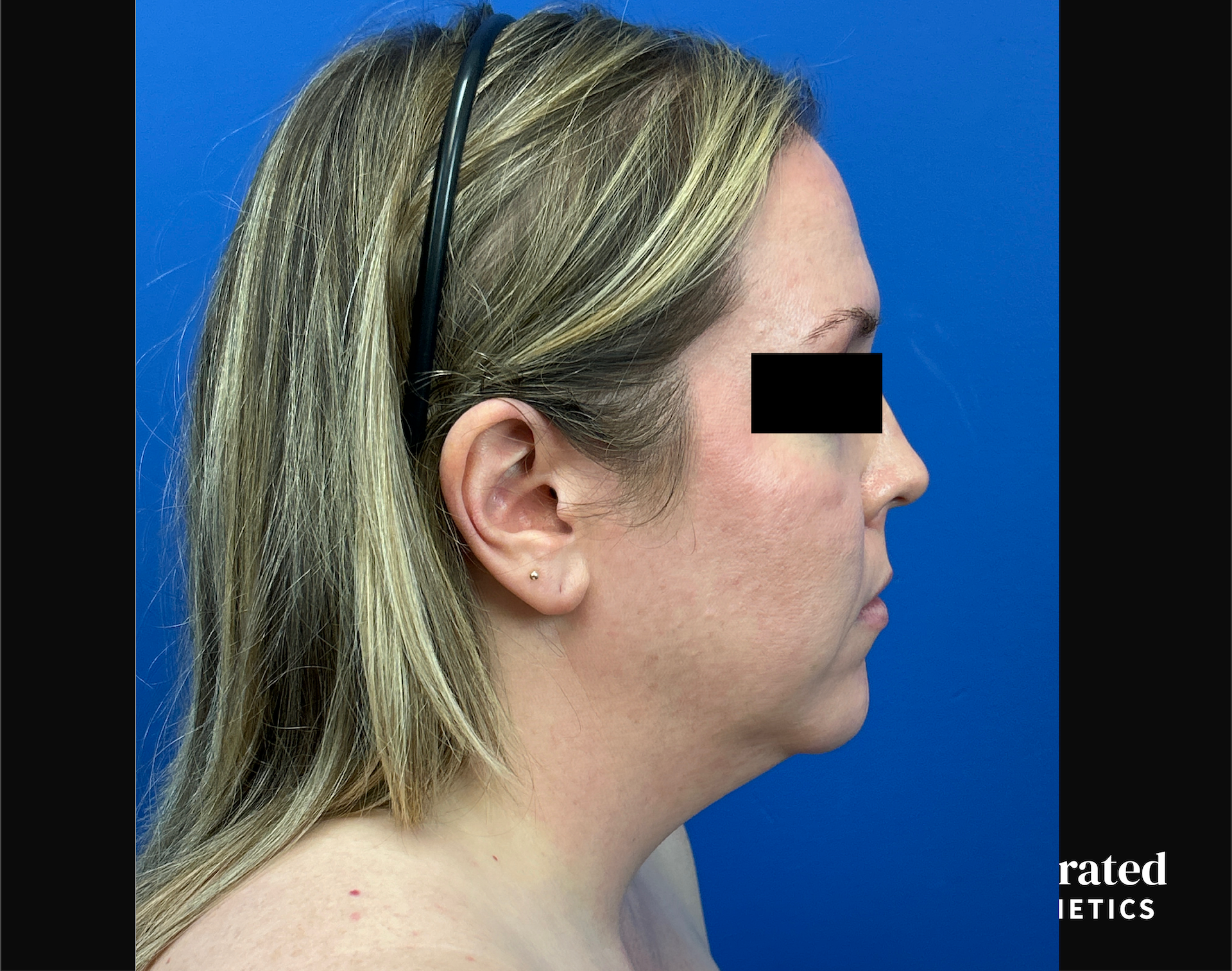 Facelift & Neck Lift Before & After Gallery - Patient 746941 - Image 5