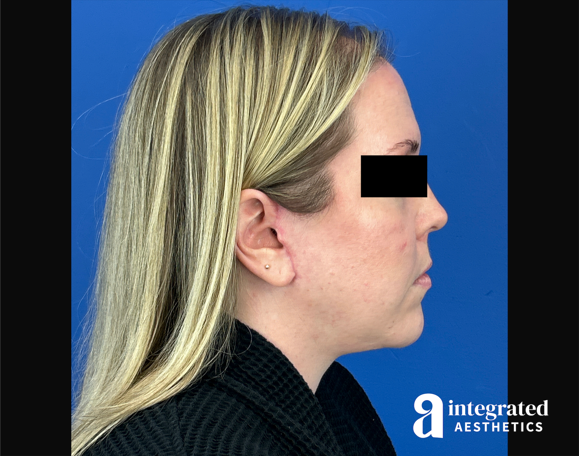 Facelift & Neck Lift Before & After Gallery - Patient 746941 - Image 6