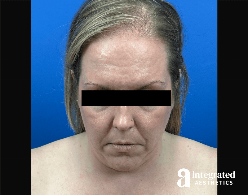 Facelift & Neck Lift Before & After Gallery - Patient 746941 - Image 13