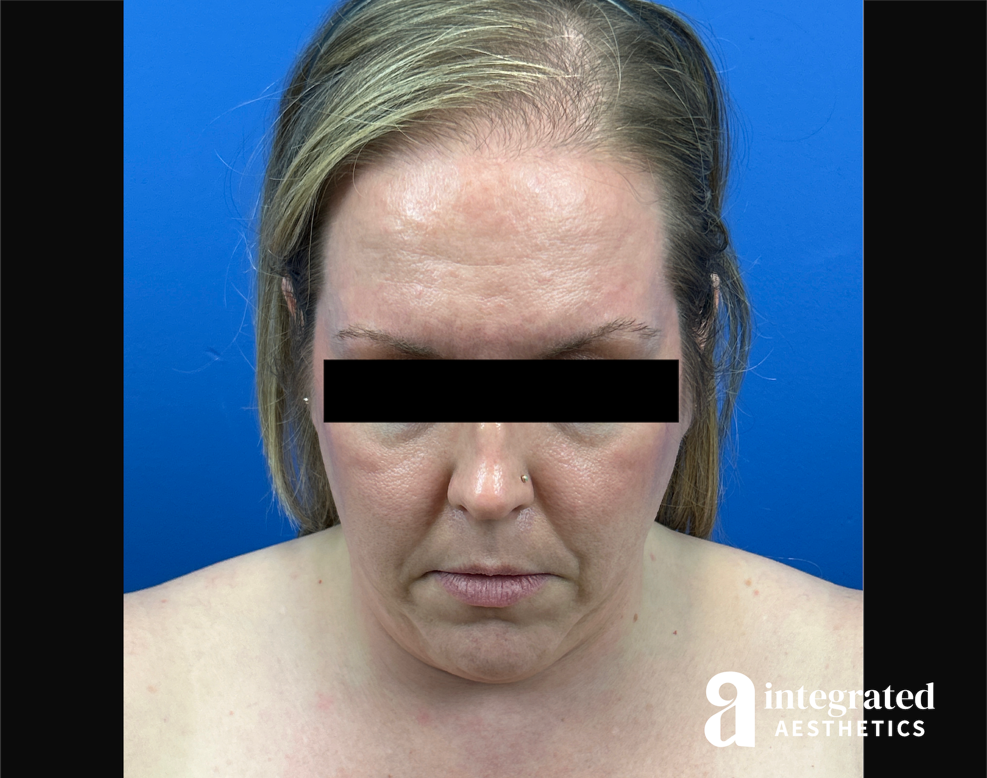 Facelift & Neck Lift Before & After Gallery - Patient 746941 - Image 13