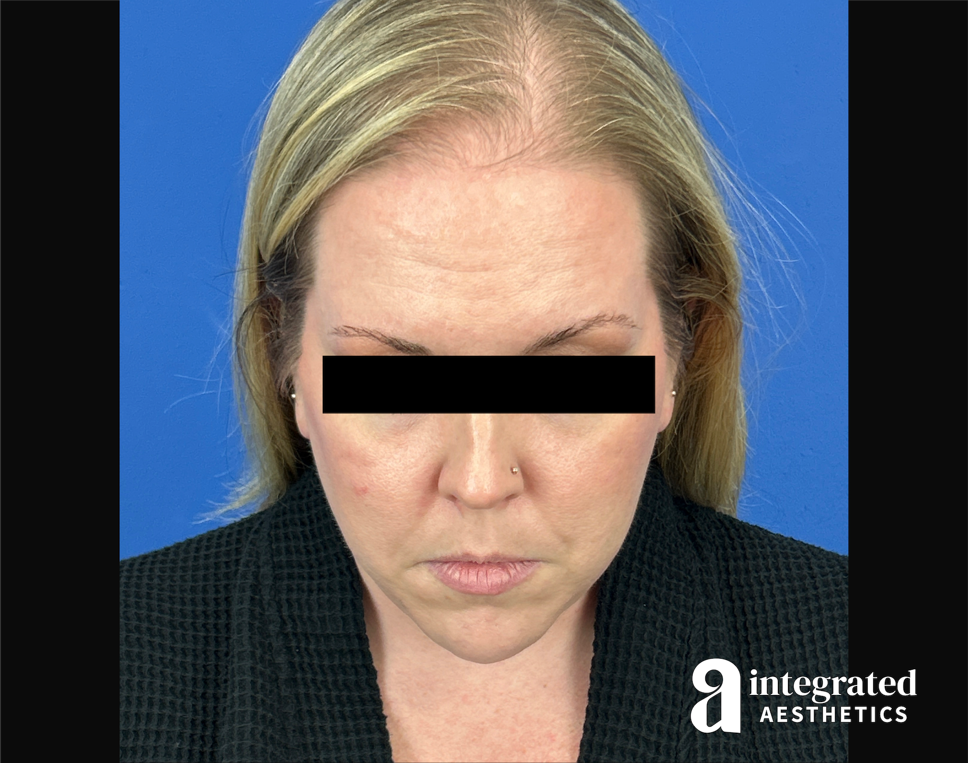 Facelift & Neck Lift Before & After Gallery - Patient 746941 - Image 14