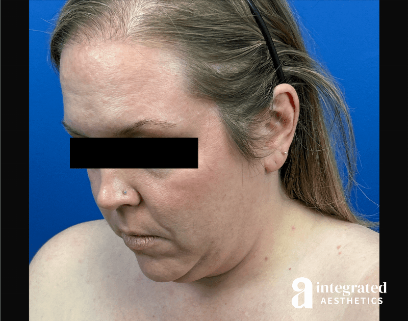 Facelift & Neck Lift Before & After Gallery - Patient 746941 - Image 9