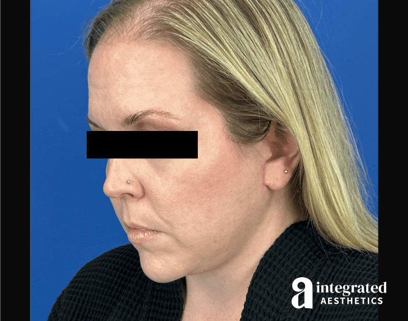 Facelift & Neck Lift Before & After Gallery - Patient 746941 - Image 10