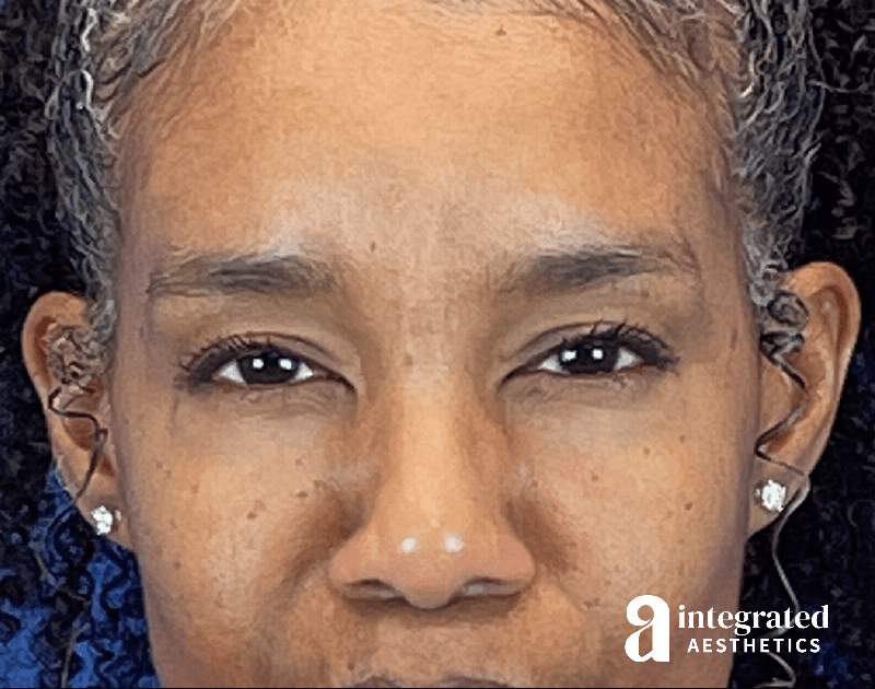 Wrinkle Relaxers Before & After Gallery - Patient 688068 - Image 2