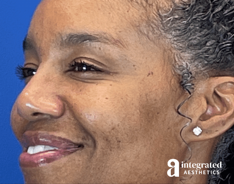 Wrinkle Relaxers Before & After Gallery - Patient 688068 - Image 6