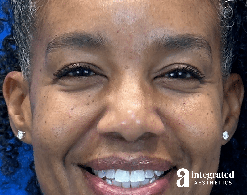 Wrinkle Relaxers Before & After Gallery - Patient 688068 - Image 3