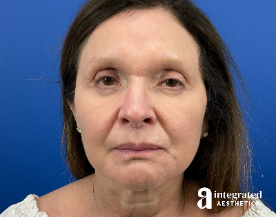 Facelift & Neck Lift Before & After Gallery - Patient 212264 - Image 1