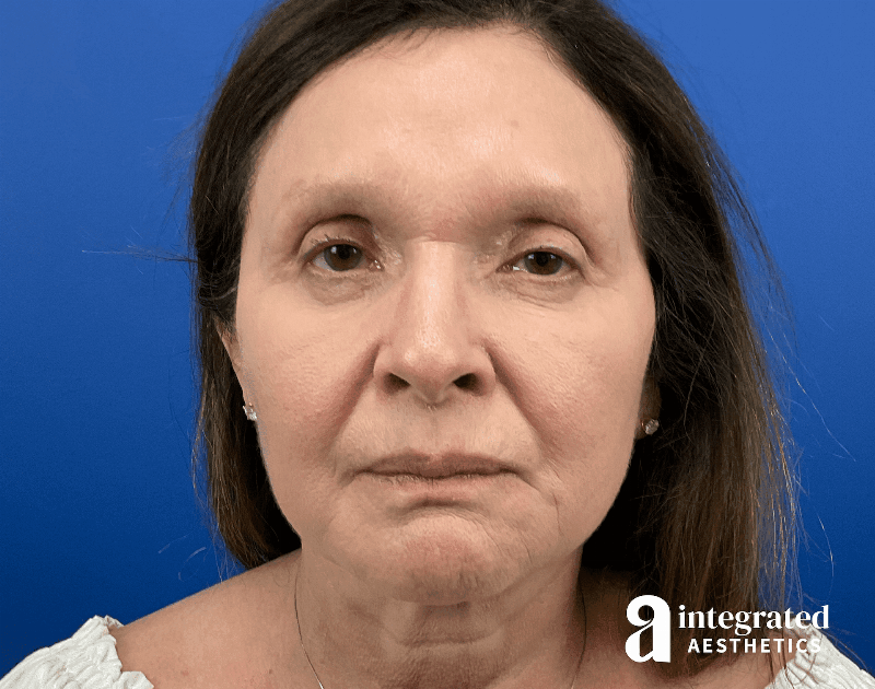 Facelift & Neck Lift Before & After Gallery - Patient 212264 - Image 1