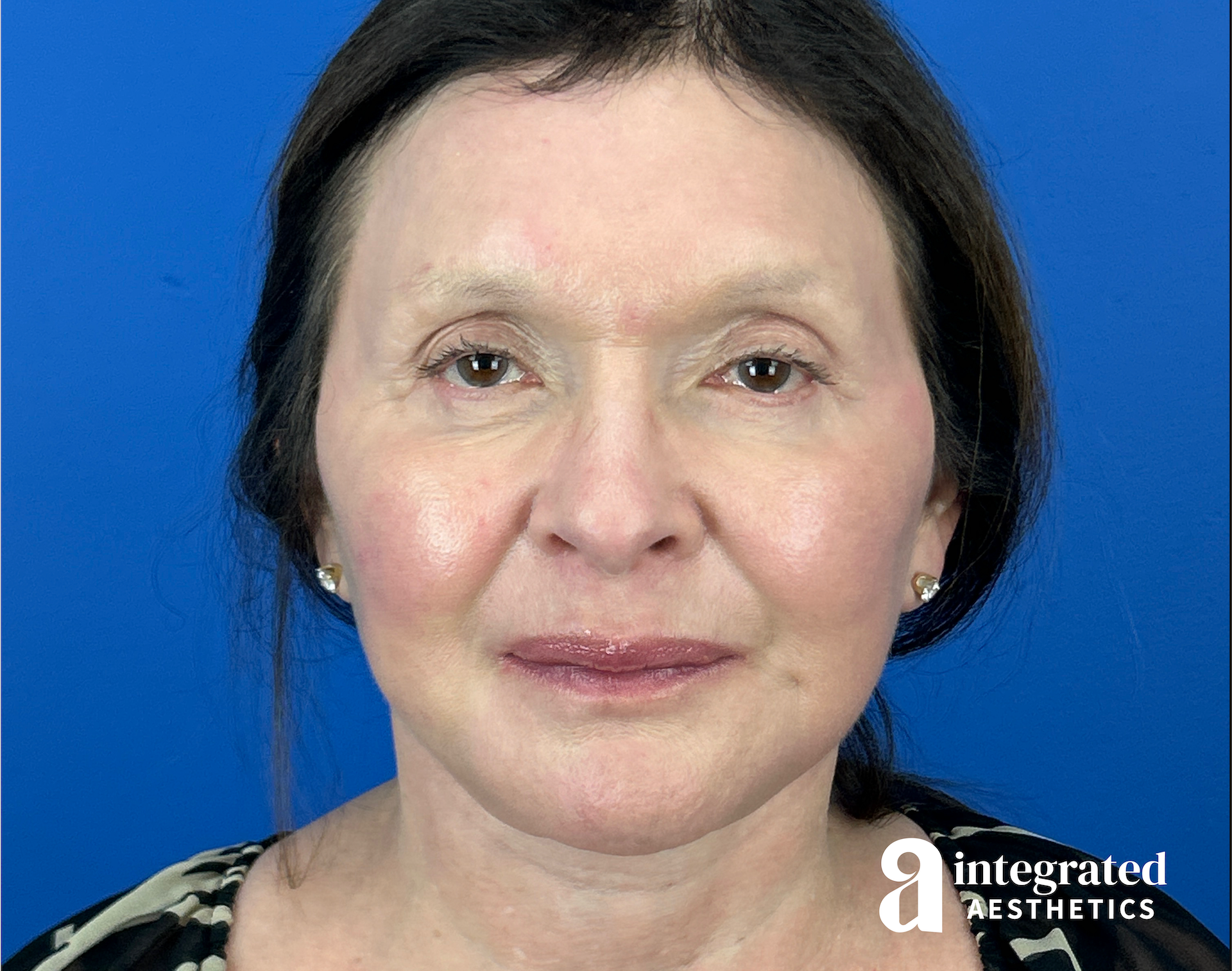 Facelift & Neck Lift Before & After Gallery - Patient 212264 - Image 2