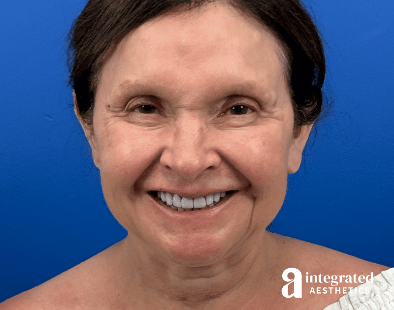 Facelift & Neck Lift Before & After Gallery - Patient 212264 - Image 3