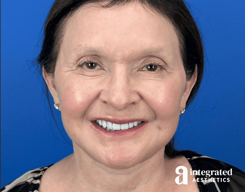 Facelift & Neck Lift Before & After Gallery - Patient 212264 - Image 4