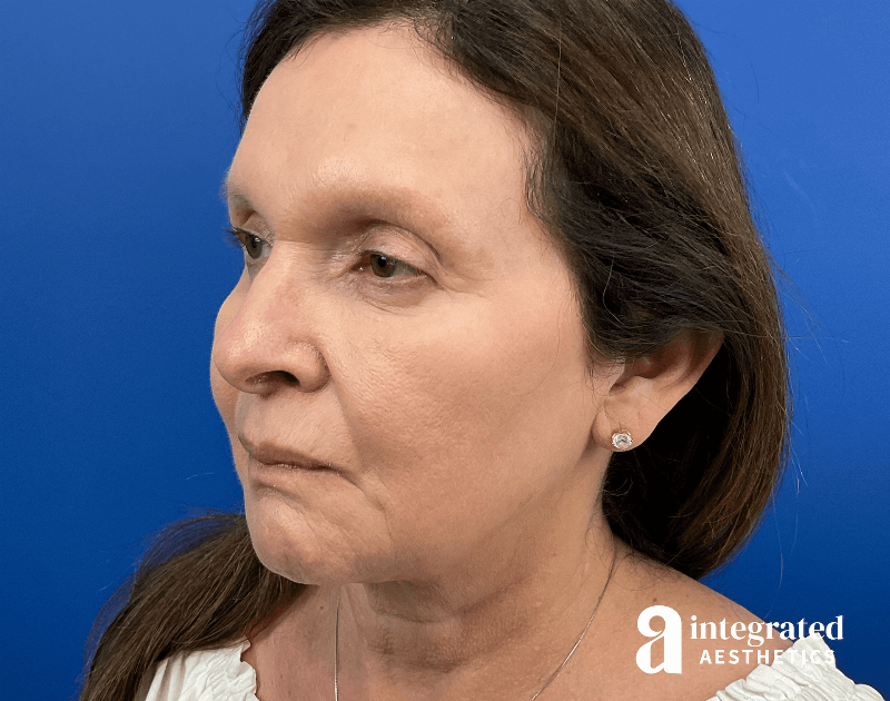 Facelift & Neck Lift Before & After Gallery - Patient 212264 - Image 5