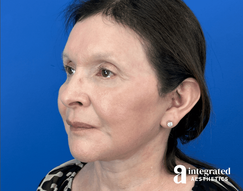 Facelift & Neck Lift Before & After Gallery - Patient 212264 - Image 6