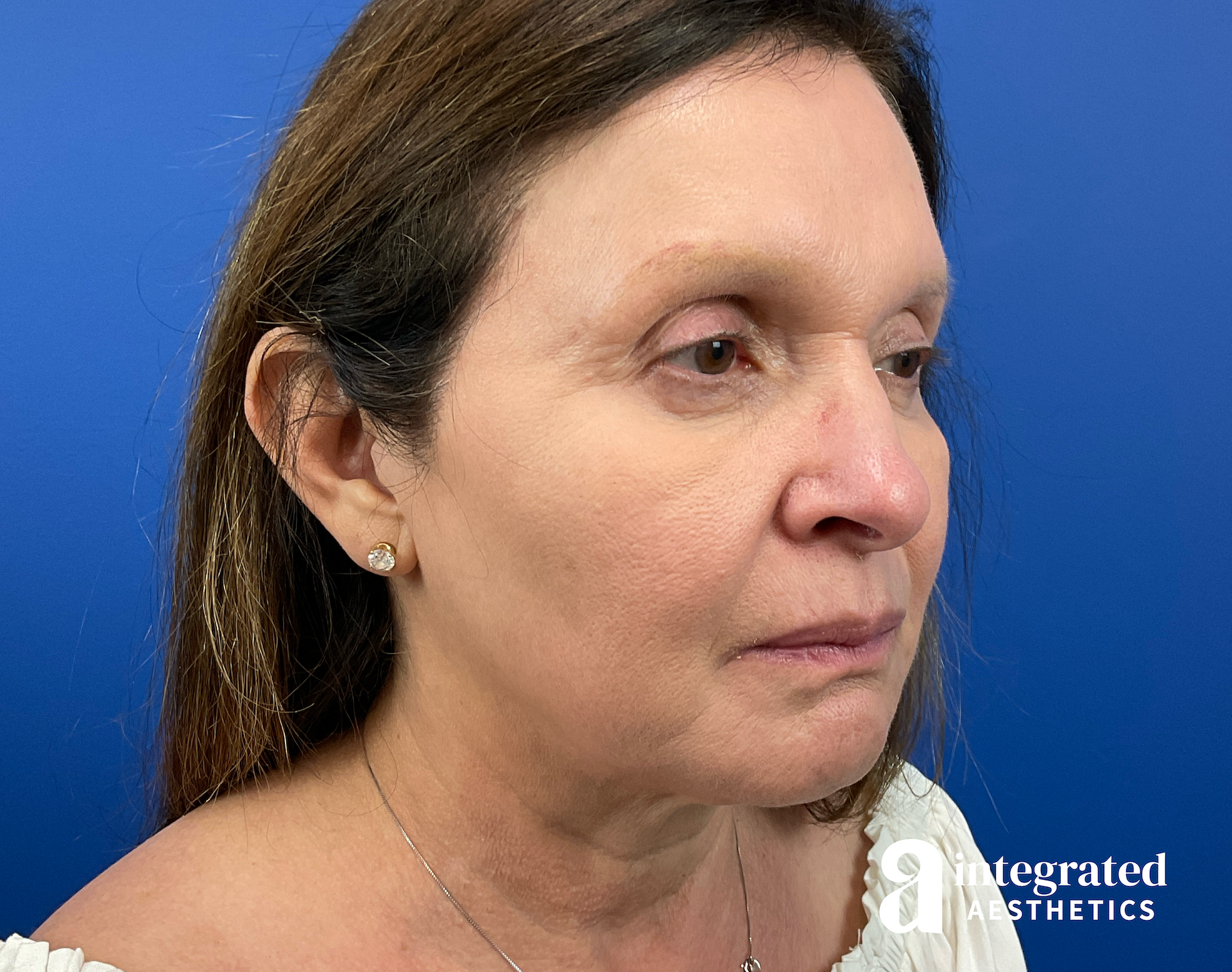 Facelift & Neck Lift Before & After Gallery - Patient 212264 - Image 9