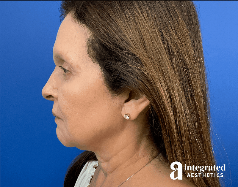 Facelift & Neck Lift Before & After Gallery - Patient 212264 - Image 7