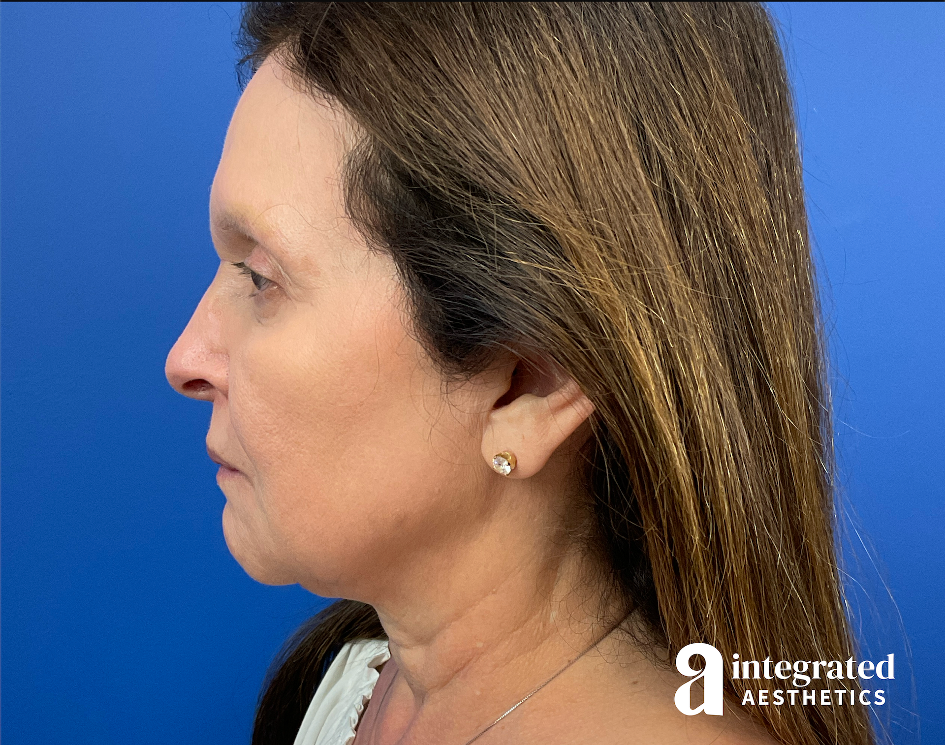 Facelift & Neck Lift Before & After Gallery - Patient 212264 - Image 7