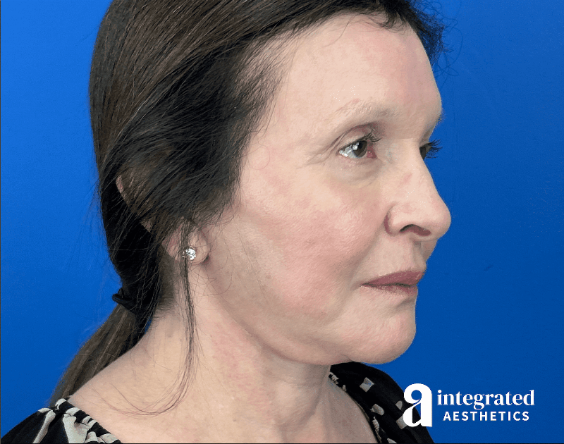 Facelift & Neck Lift Before & After Gallery - Patient 212264 - Image 10