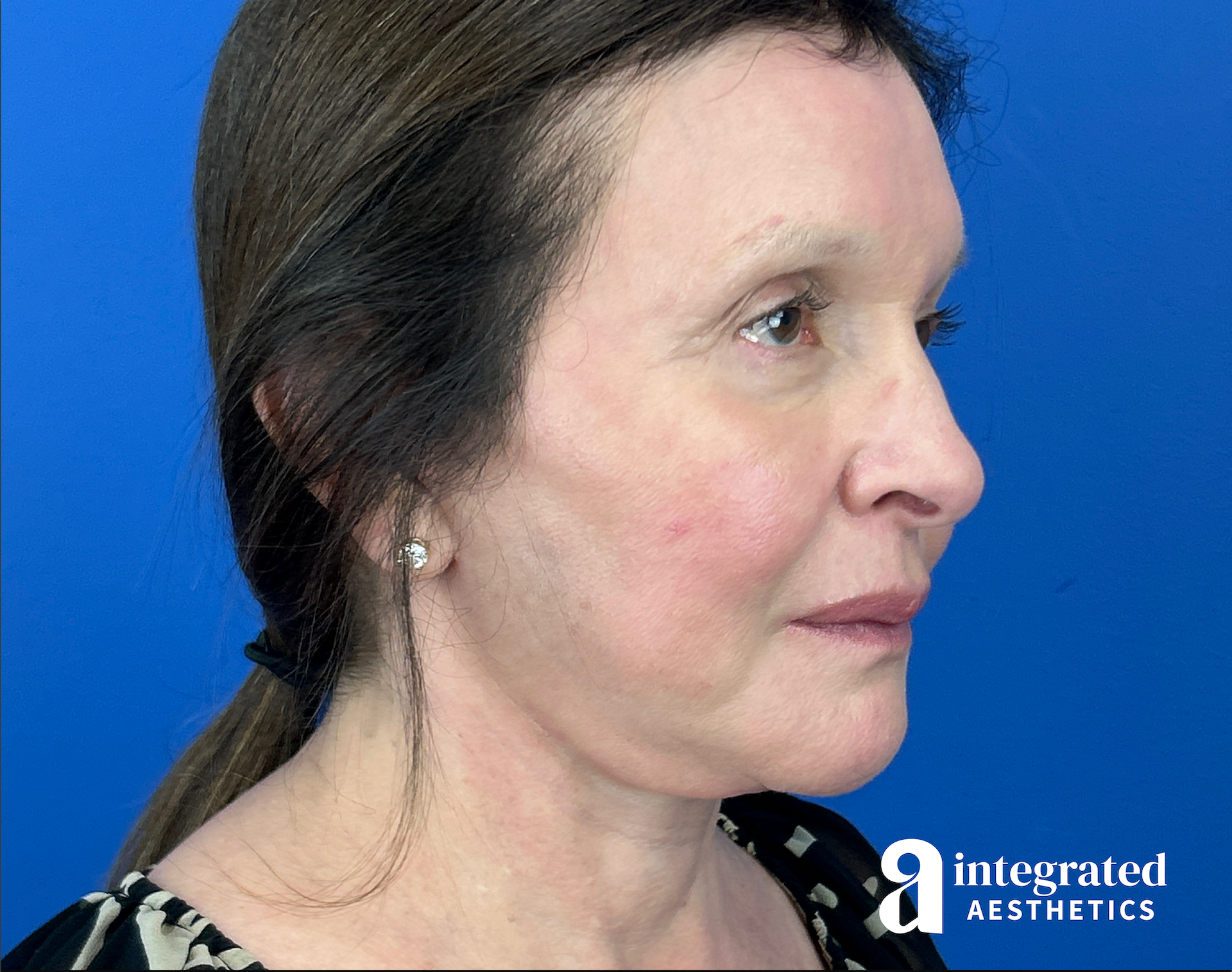 Facelift & Neck Lift Before & After Gallery - Patient 212264 - Image 10