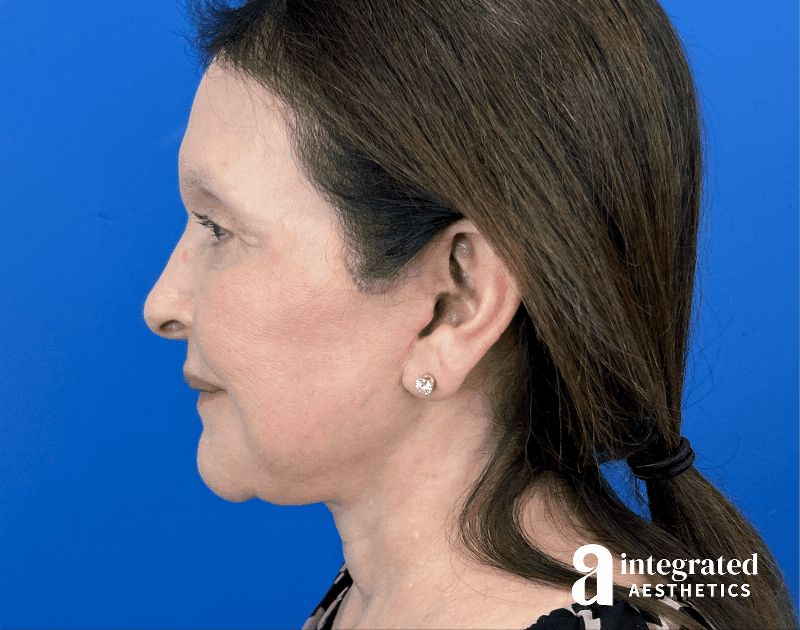 Facelift & Neck Lift Before & After Gallery - Patient 212264 - Image 8