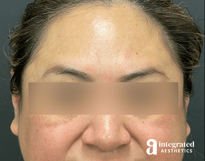 Wrinkle Relaxers Before & After Gallery - Patient 930885 - Image 2