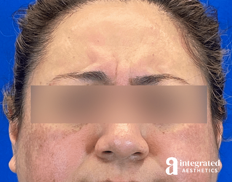 Wrinkle Relaxers Before & After Gallery - Patient 930885 - Image 3