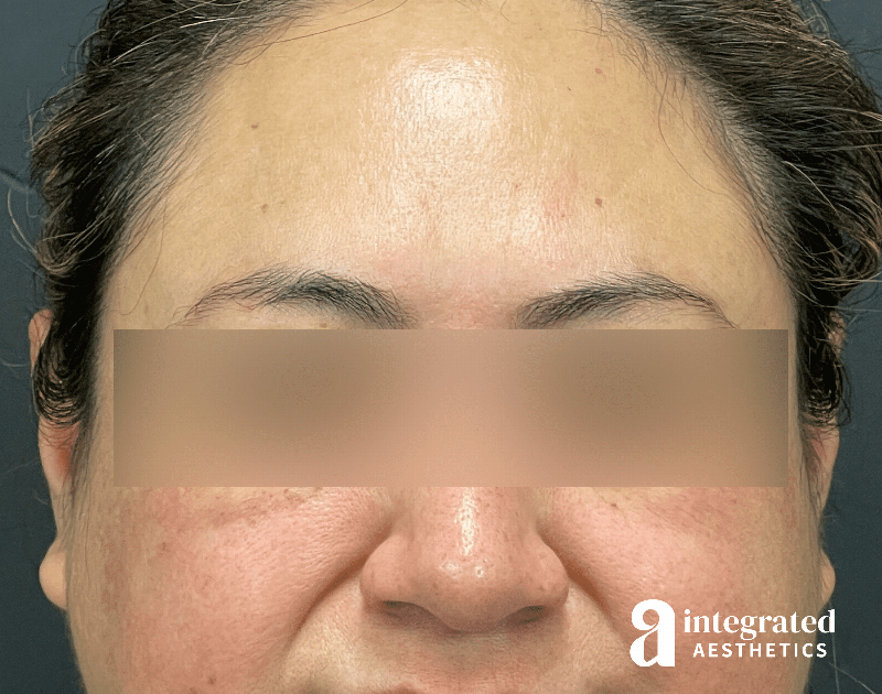 Wrinkle Relaxers Before & After Gallery - Patient 930885 - Image 4