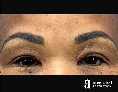 Blepharoplasty Before & After Gallery - Patient 341086 - Image 1