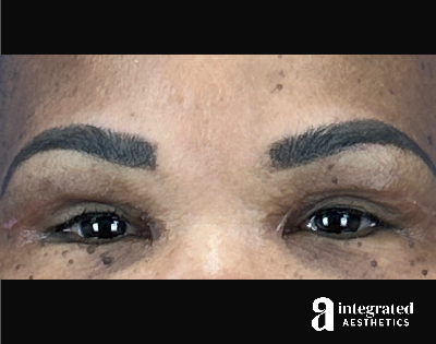 Blepharoplasty Before & After Gallery - Patient 341086 - Image 2