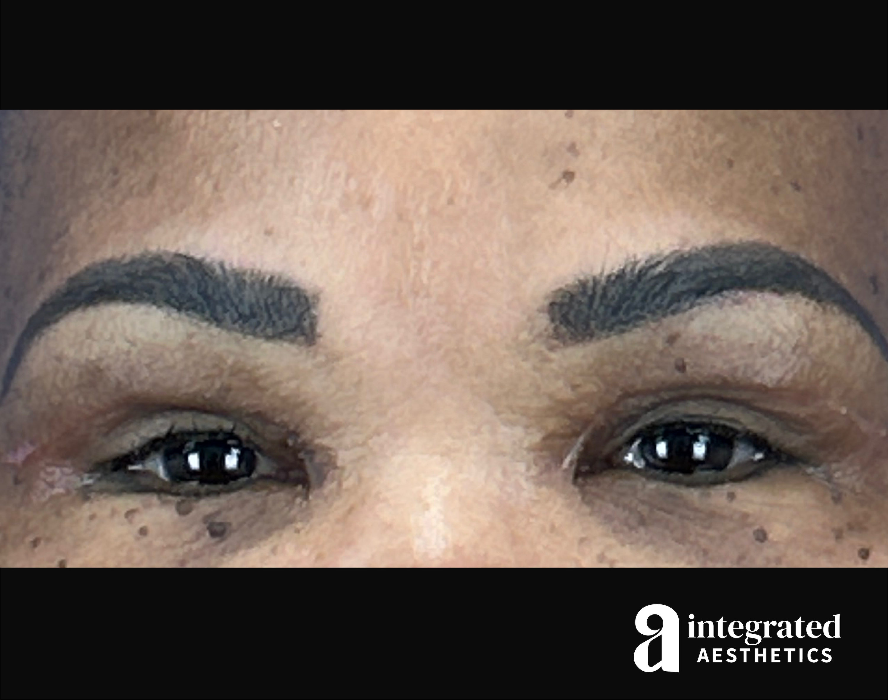 Blepharoplasty Before & After Gallery - Patient 341086 - Image 2