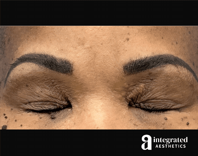 Blepharoplasty Before & After Gallery - Patient 341086 - Image 3