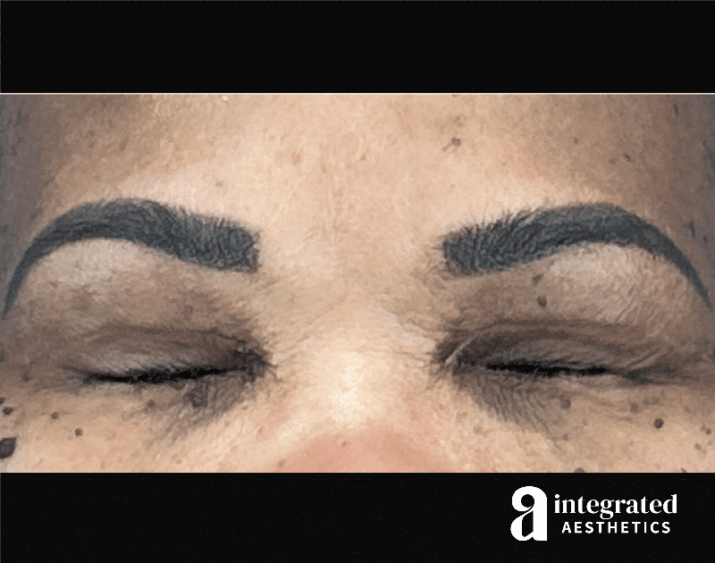 Blepharoplasty Before & After Gallery - Patient 341086 - Image 4