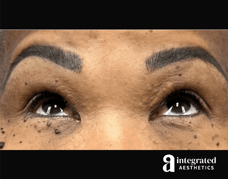 Blepharoplasty Before & After Gallery - Patient 341086 - Image 5