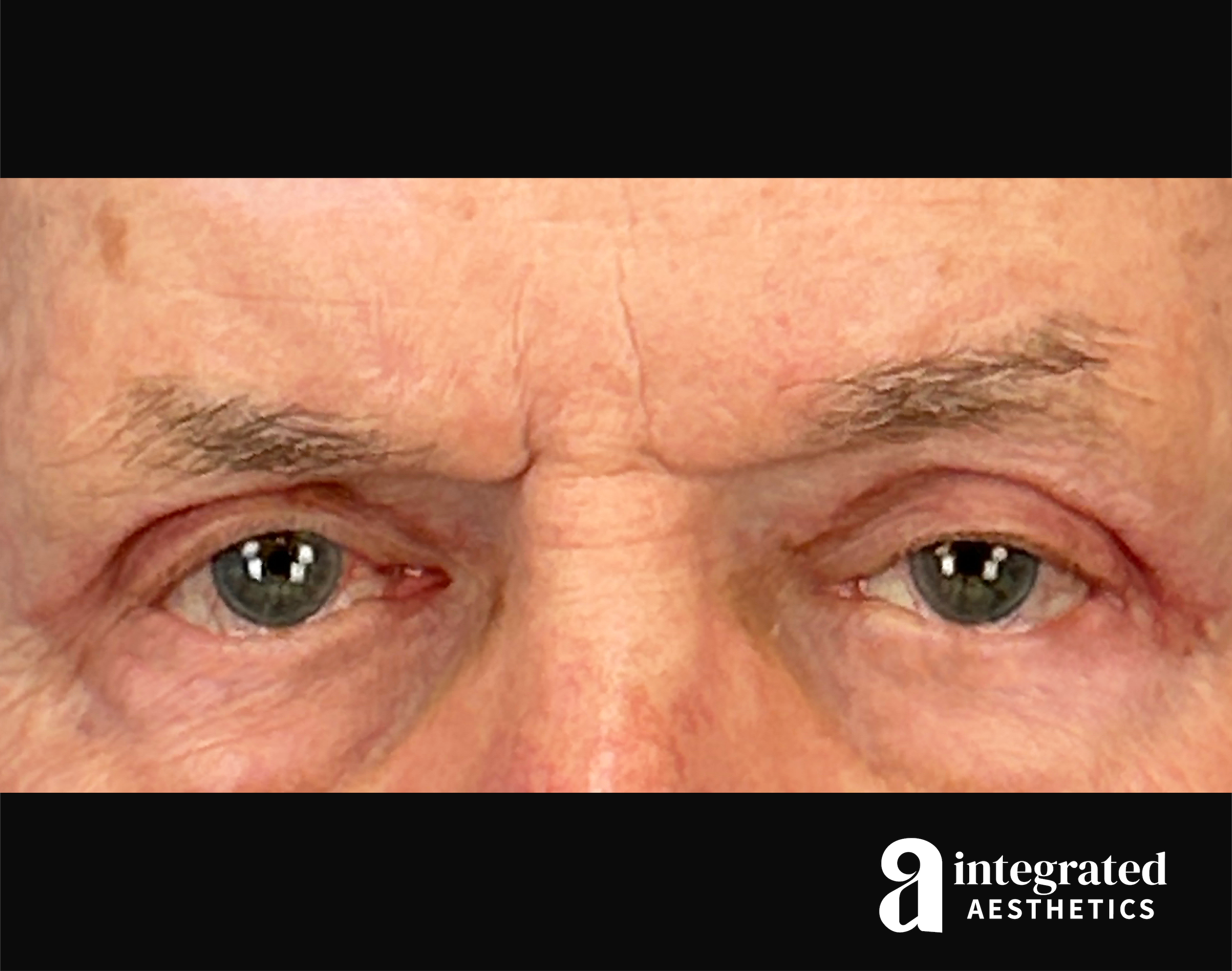 Blepharoplasty Before & After Gallery - Patient 100455 - Image 2