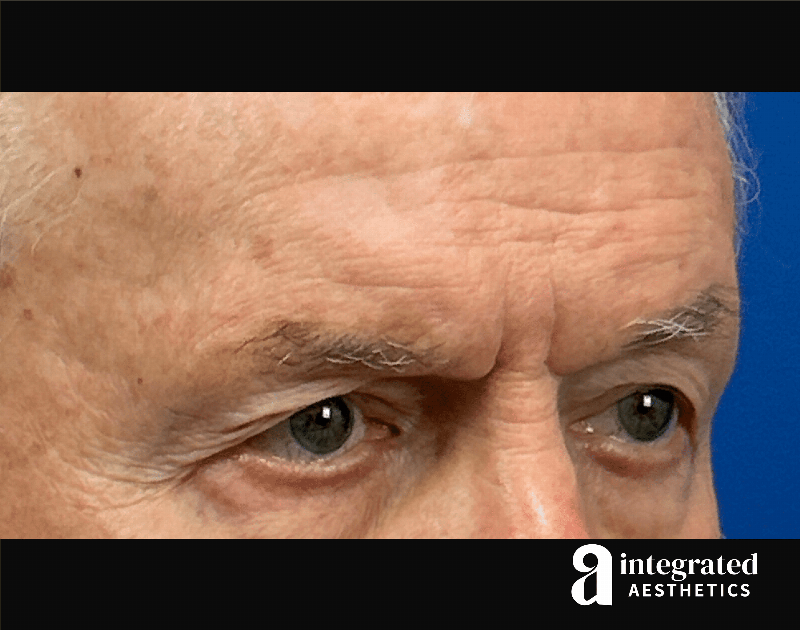 Blepharoplasty Before & After Gallery - Patient 100455 - Image 5