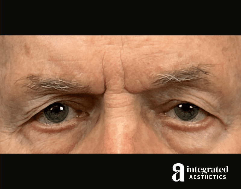 Blepharoplasty Before & After Gallery - Patient 100455 - Image 1