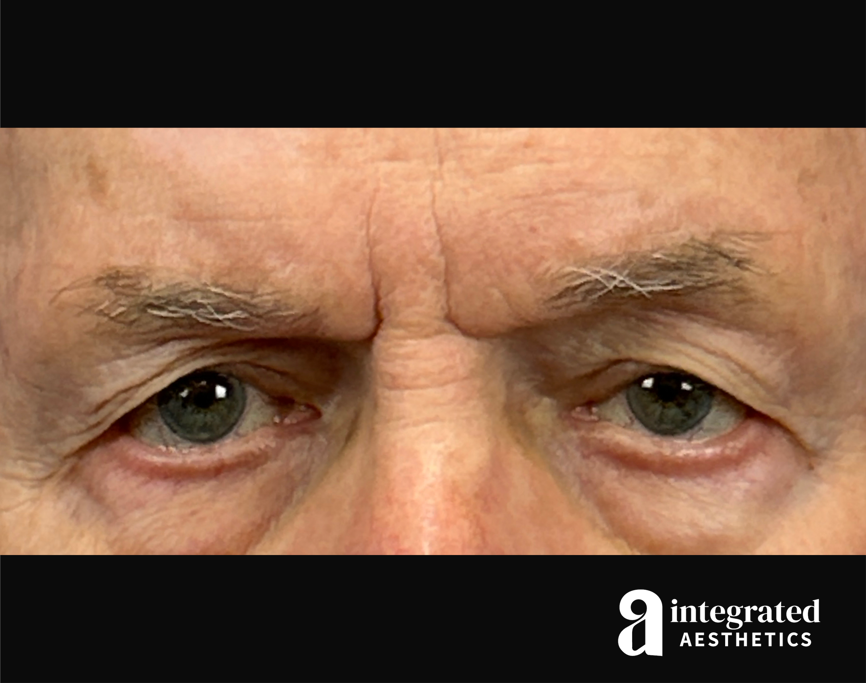 Blepharoplasty Before & After Gallery - Patient 100455 - Image 1