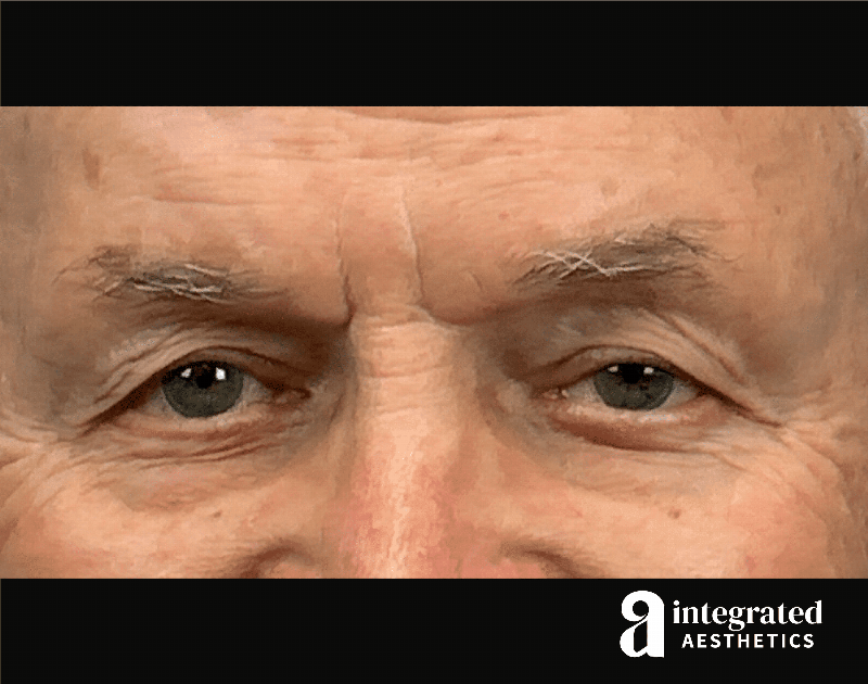 Blepharoplasty Before & After Gallery - Patient 100455 - Image 3