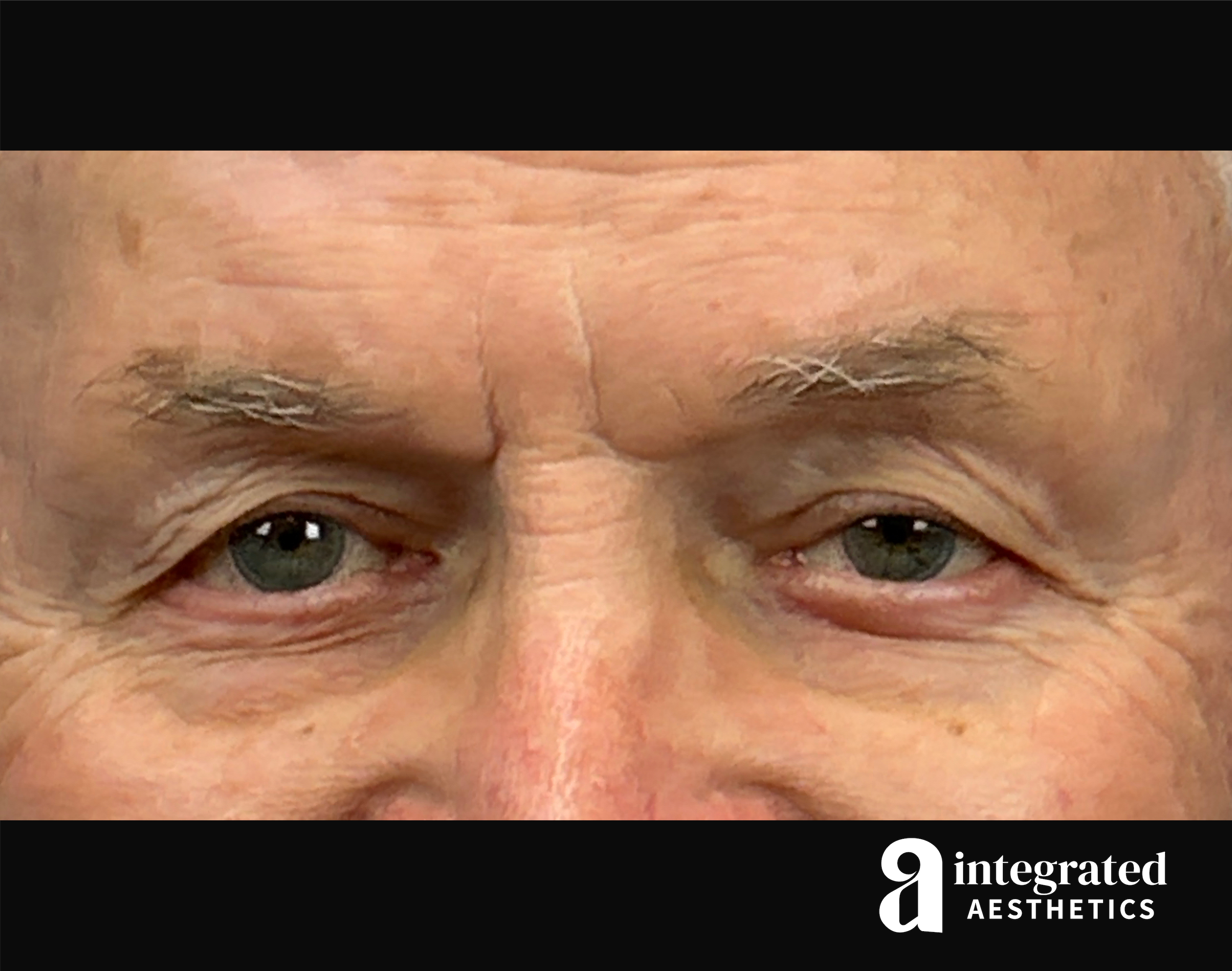 Blepharoplasty Before & After Gallery - Patient 100455 - Image 3