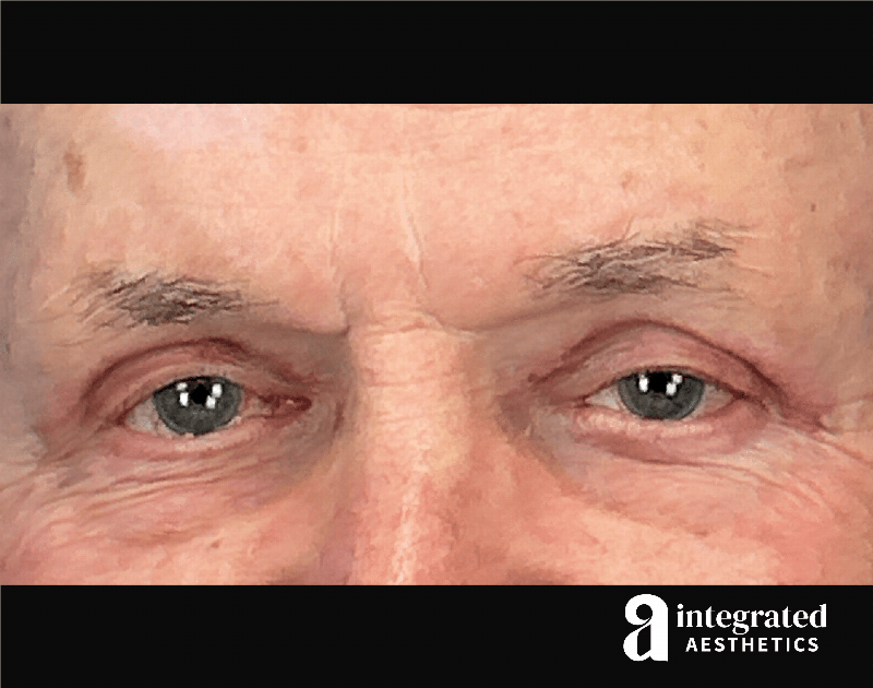 Blepharoplasty Before & After Gallery - Patient 100455 - Image 4