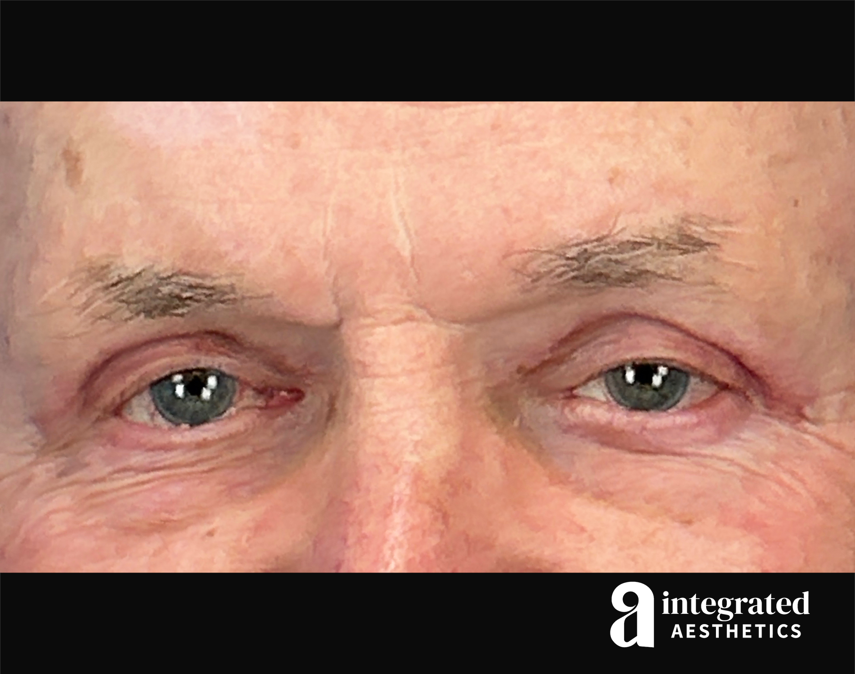 Blepharoplasty Before & After Gallery - Patient 100455 - Image 4