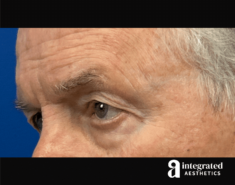 Blepharoplasty Before & After Gallery - Patient 100455 - Image 7